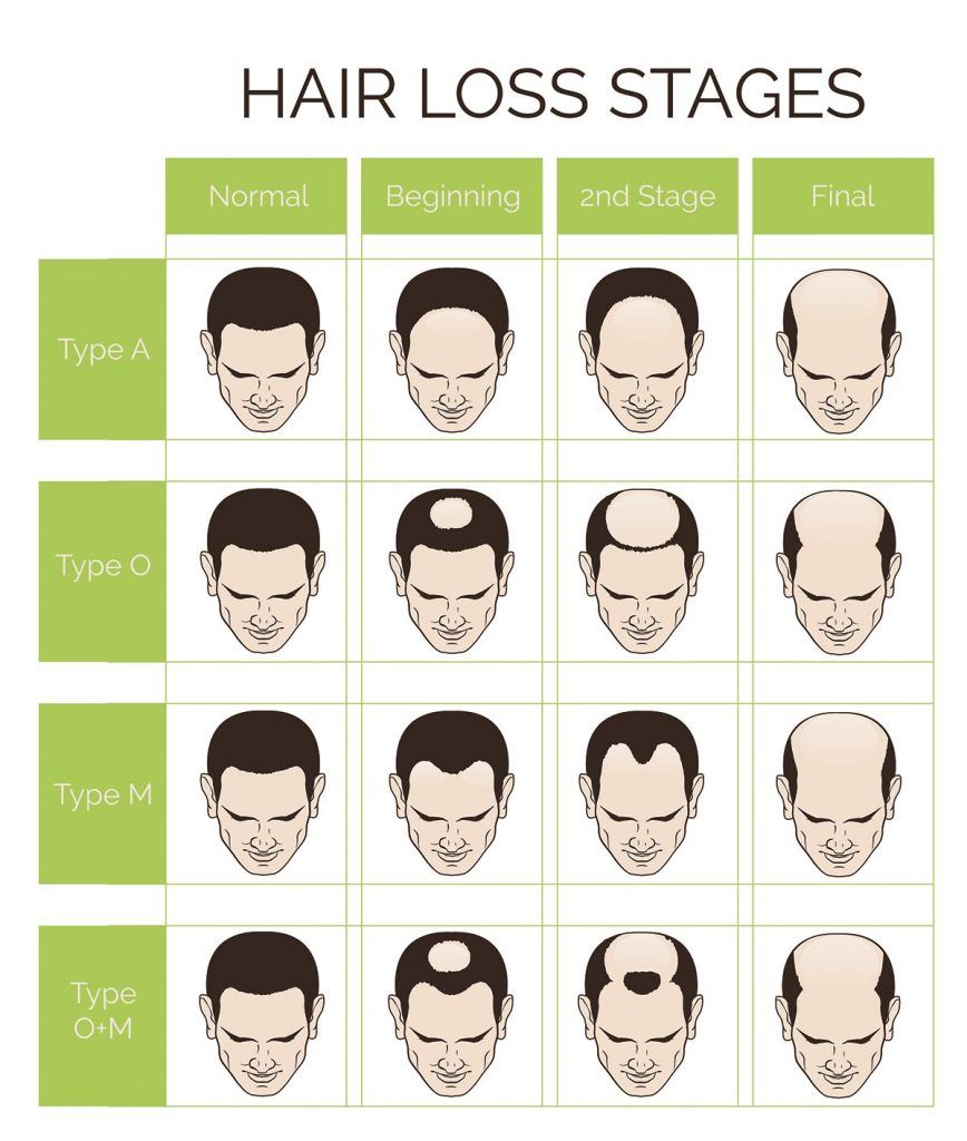Symptoms To Understand That You Are Losing Hair #recedinghairline